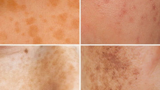 Dark spots grid images